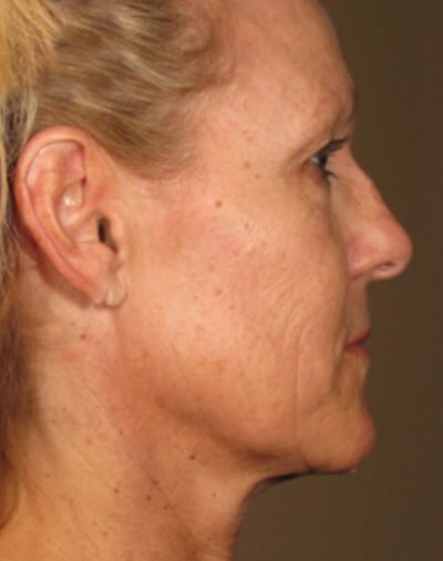 Ulthera Before & After Gallery - Patient 303722 - Image 2