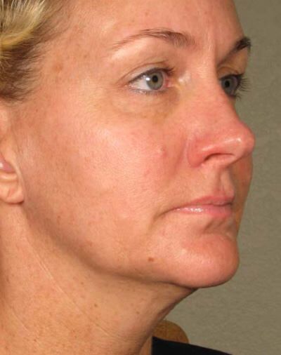 Ulthera Before & After Gallery - Patient 137025 - Image 1