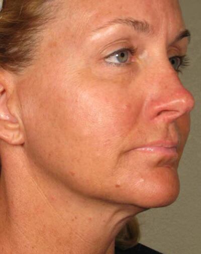 Ulthera Before & After Gallery - Patient 137025 - Image 2