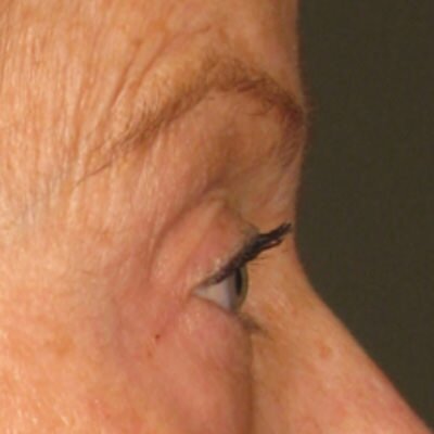 Ulthera Before & After Gallery - Patient 268633 - Image 2