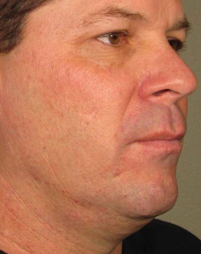 Ulthera Before & After Gallery - Patient 952434 - Image 1