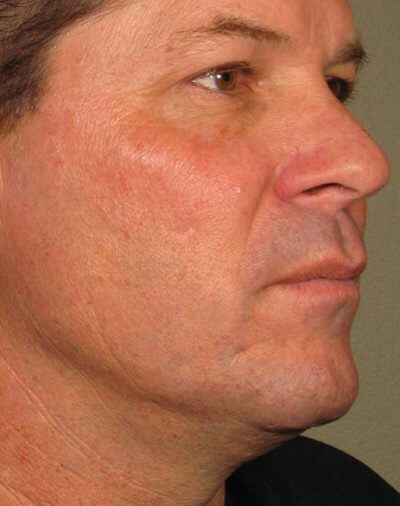 Ulthera Before & After Gallery - Patient 952434 - Image 2