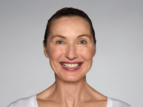 Restylane Refyne Before & After Gallery - Patient 134372 - Image 1