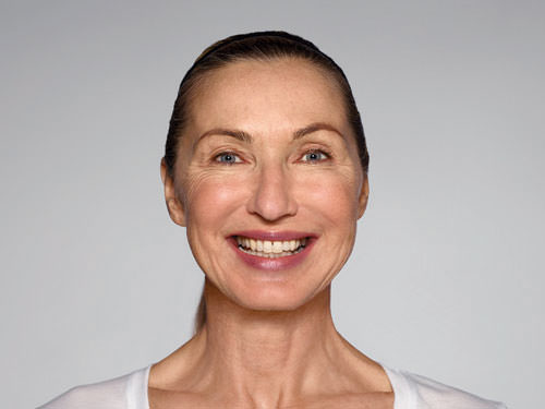 Restylane Refyne Before & After Gallery - Patient 134372 - Image 2