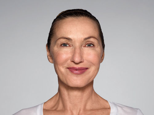 Restylane Refyne Before & After Gallery - Patient 134372 - Image 4