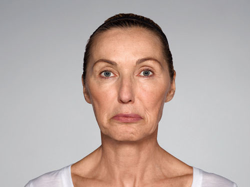 Restylane Refyne Before & After Gallery - Patient 134372 - Image 5