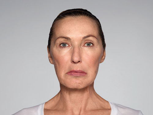 Restylane Refyne Before & After Gallery - Patient 134372 - Image 6