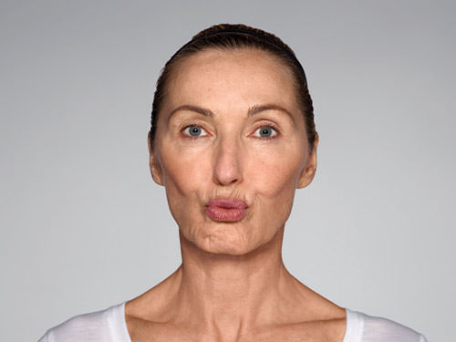 Restylane Refyne Before & After Gallery - Patient 134372 - Image 7