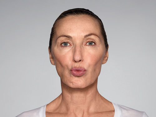 Restylane Refyne Before & After Gallery - Patient 134372 - Image 8