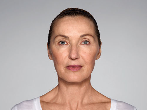 Restylane Refyne Before & After Gallery - Patient 134372 - Image 9