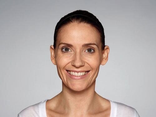 Restylane Defyne Before & After Gallery - Patient 216263 - Image 1