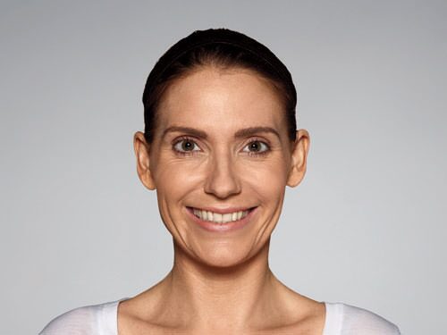 Restylane Defyne Before & After Gallery - Patient 216263 - Image 2