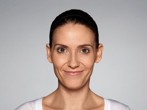 Restylane Defyne Before & After Gallery - Patient 216263 - Image 3