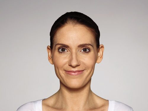 Restylane Defyne Before & After Gallery - Patient 216263 - Image 4