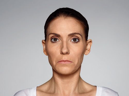 Restylane Defyne Before & After Gallery - Patient 216263 - Image 6