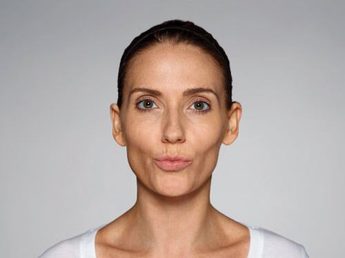 Restylane Defyne Before & After Gallery - Patient 216263 - Image 7