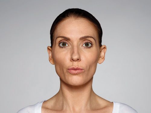 Restylane Defyne Before & After Gallery - Patient 216263 - Image 8