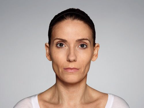 Restylane Defyne Before & After Gallery - Patient 216263 - Image 9