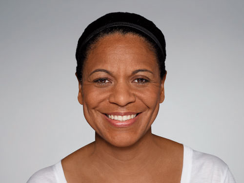 Restylane Defyne Before & After Gallery - Patient 123437 - Image 1