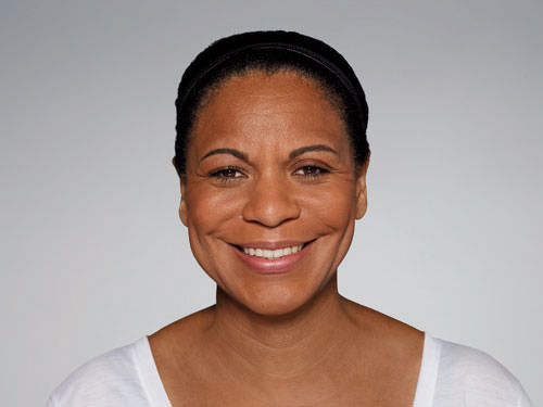 Restylane Defyne Before & After Gallery - Patient 123437 - Image 2