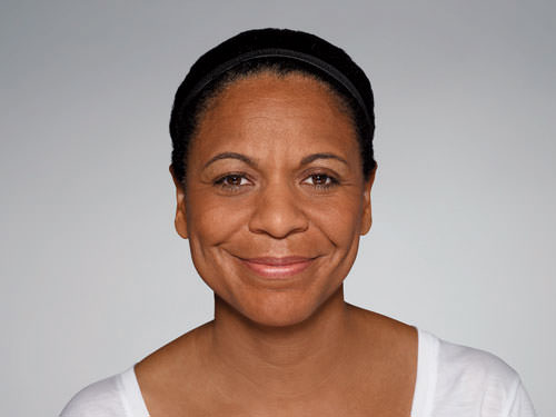 Restylane Defyne Before & After Gallery - Patient 123437 - Image 3