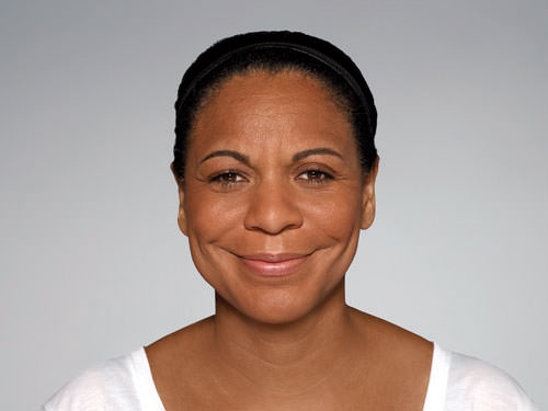 Restylane Defyne Before & After Gallery - Patient 123437 - Image 4