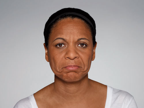 Restylane Defyne Before & After Gallery - Patient 123437 - Image 5