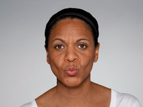 Restylane Defyne Before & After Gallery - Patient 123437 - Image 7