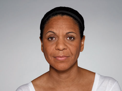 Restylane Defyne Before & After Gallery - Patient 123437 - Image 9