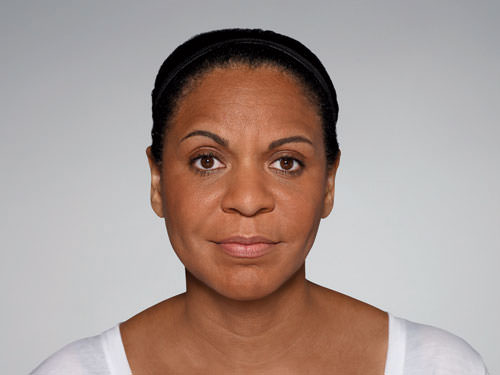 Restylane Defyne Before & After Gallery - Patient 123437 - Image 10