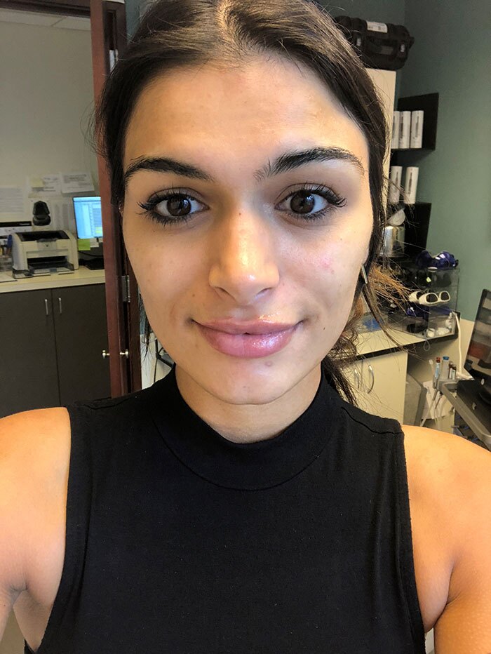 HydraFacial Before & After Gallery - Patient 171803 - Image 1