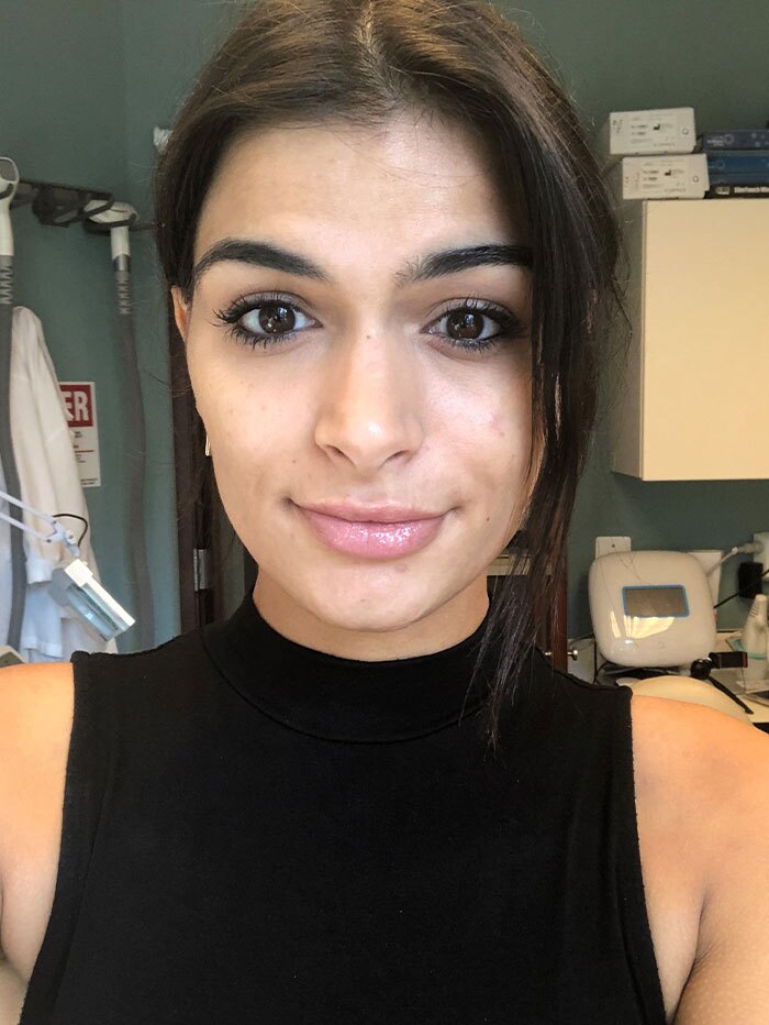 HydraFacial Before & After Gallery - Patient 171803 - Image 2