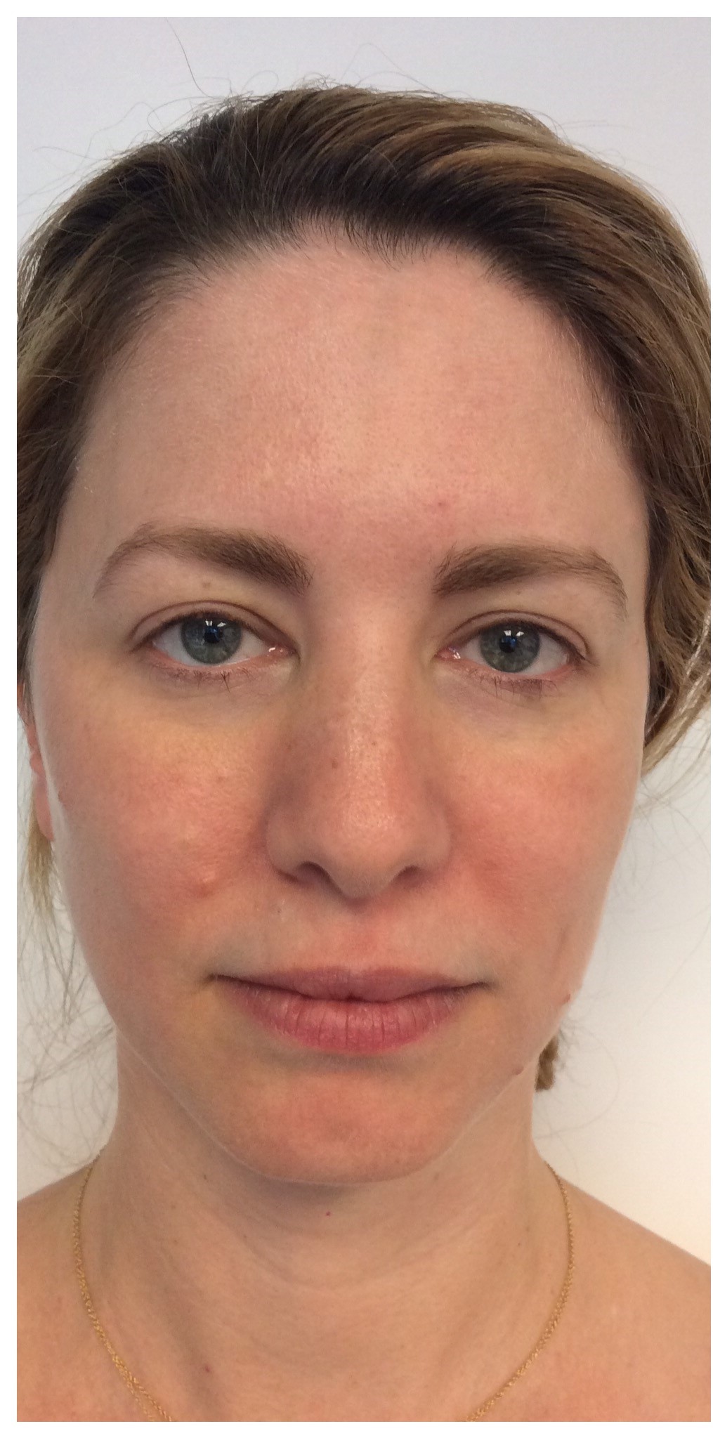 HydraFacial Before & After Gallery - Patient 360267 - Image 1