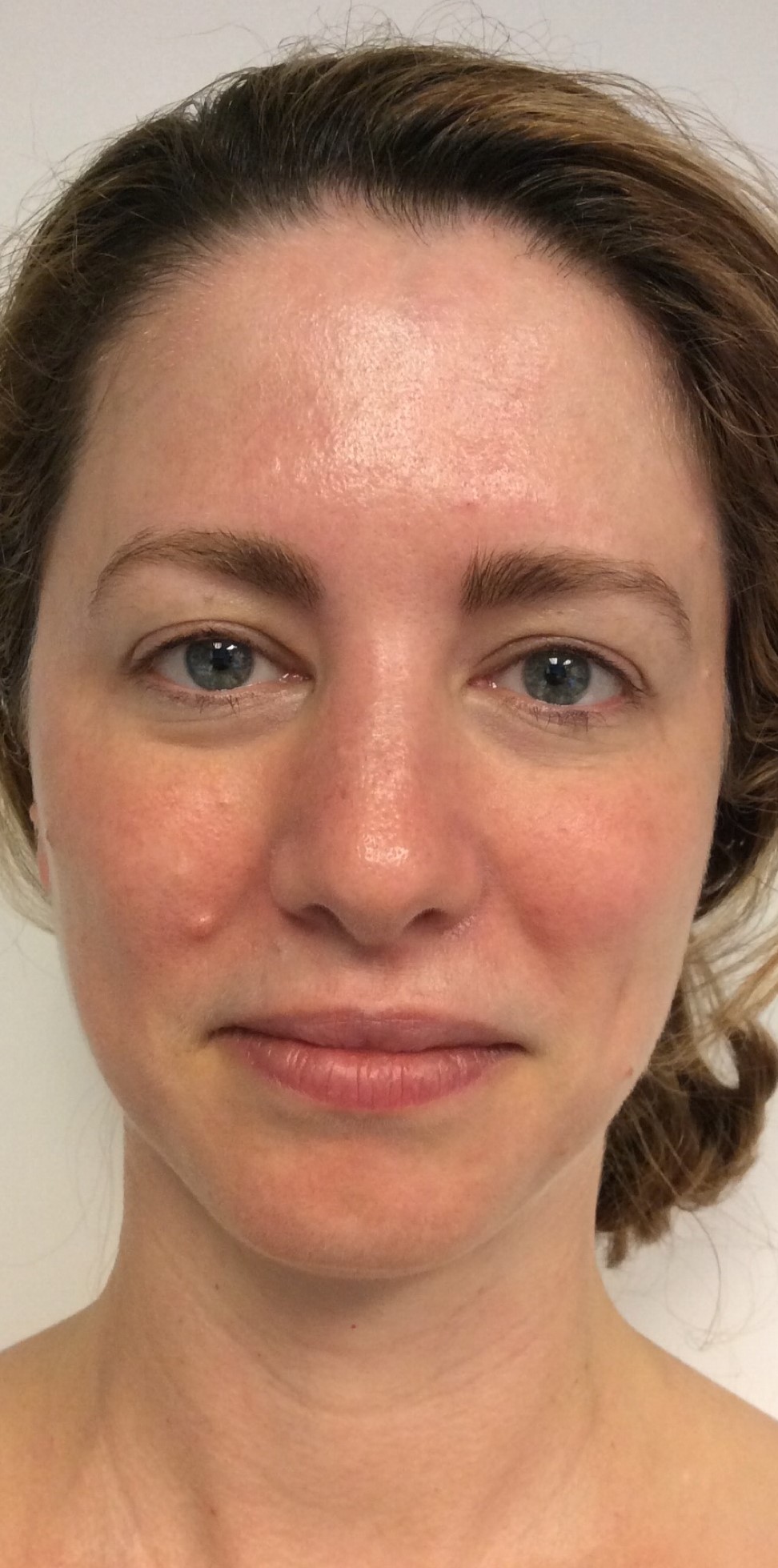 HydraFacial Before & After Gallery - Patient 360267 - Image 2