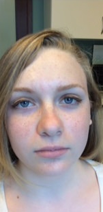 HydraFacial Before & After Gallery - Patient 444505 - Image 1