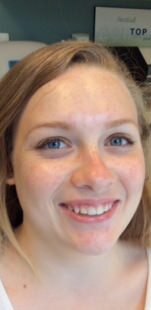 HydraFacial Before & After Gallery - Patient 444505 - Image 2