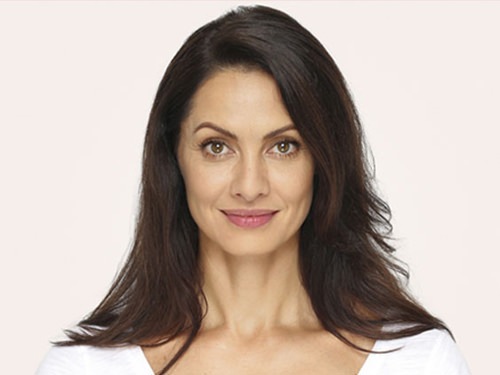 Radiesse Before & After Gallery - Patient 224271 - Image 2