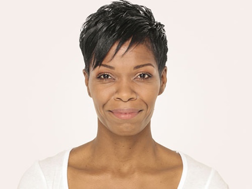 Radiesse Before & After Gallery - Patient 263525 - Image 1