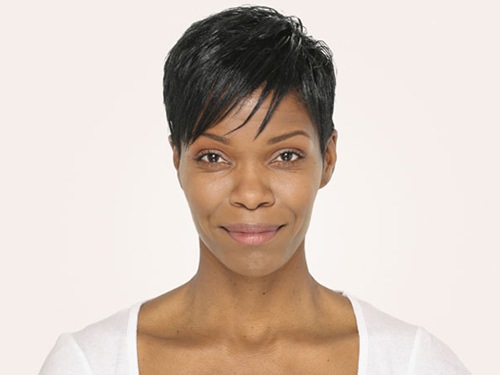 Radiesse Before & After Gallery - Patient 263525 - Image 2