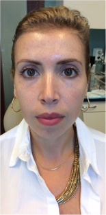 Clear and Brilliant Before & After Gallery - Patient 134322 - Image 1