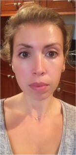 Clear and Brilliant Before & After Gallery - Patient 134322 - Image 2