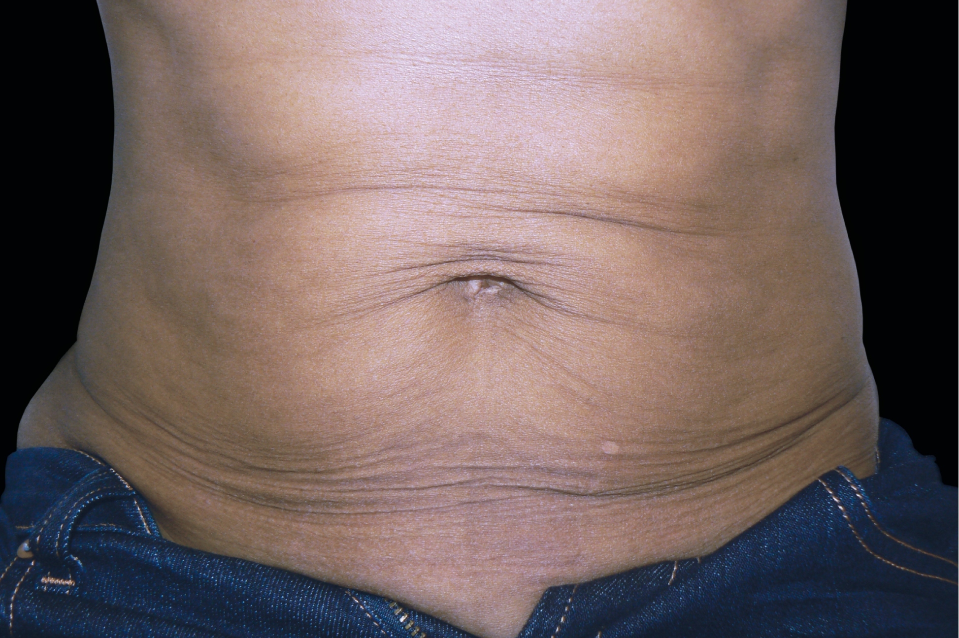 BTL Exilis Ultra Before & After Gallery - Patient 312093 - Image 1