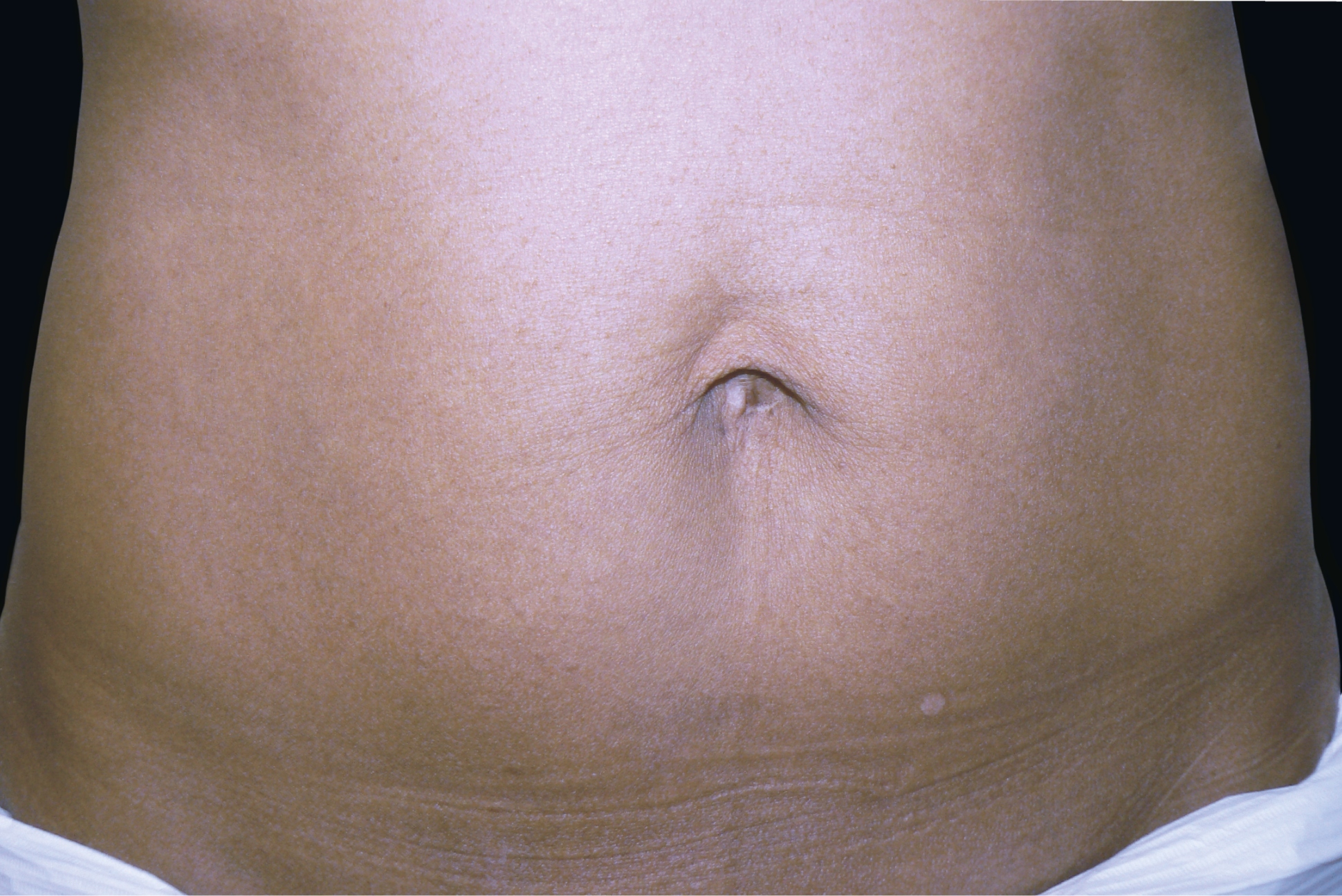 BTL Exilis Ultra Before & After Gallery - Patient 312093 - Image 2