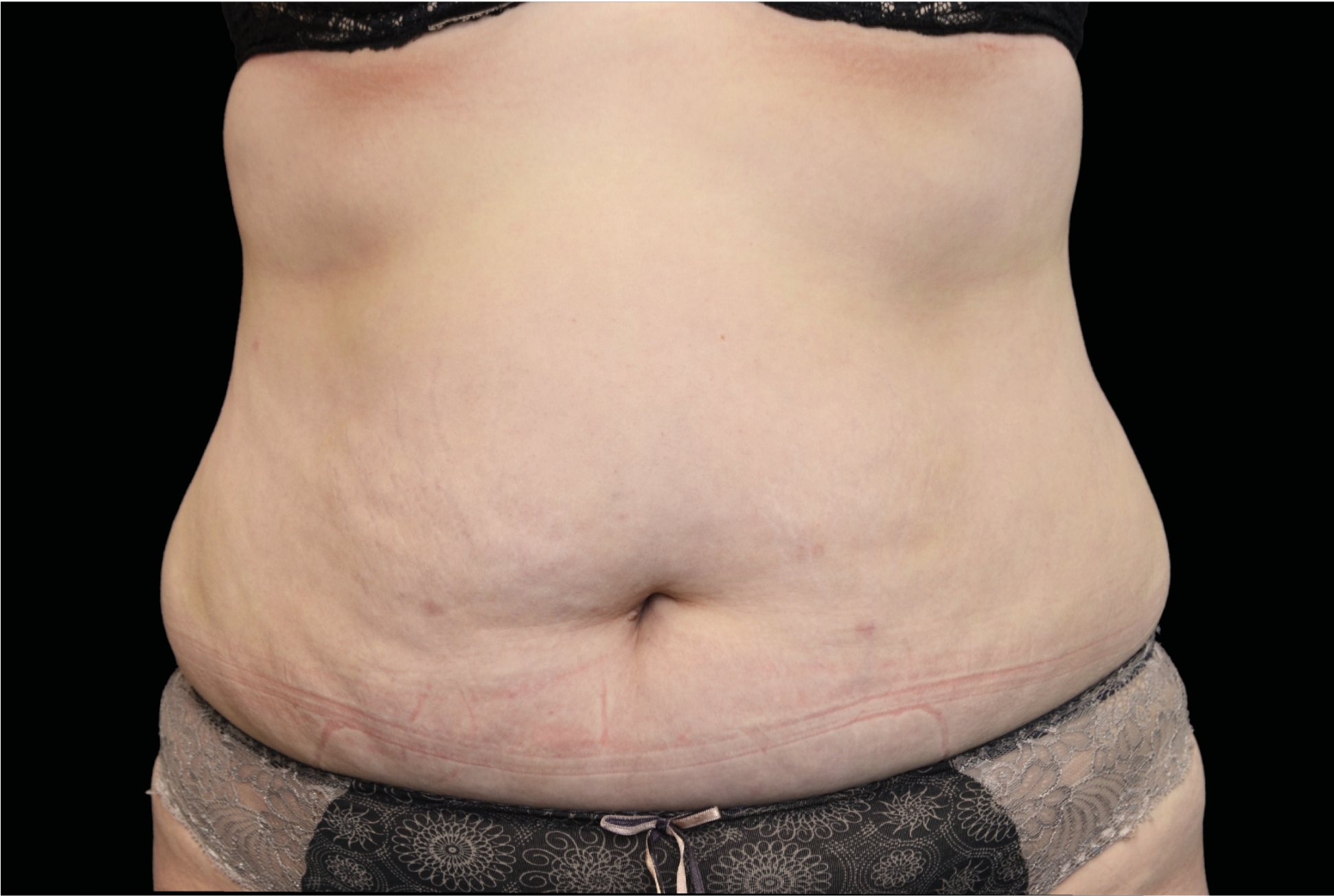 BTL Exilis Ultra Before & After Gallery - Patient 234247 - Image 1
