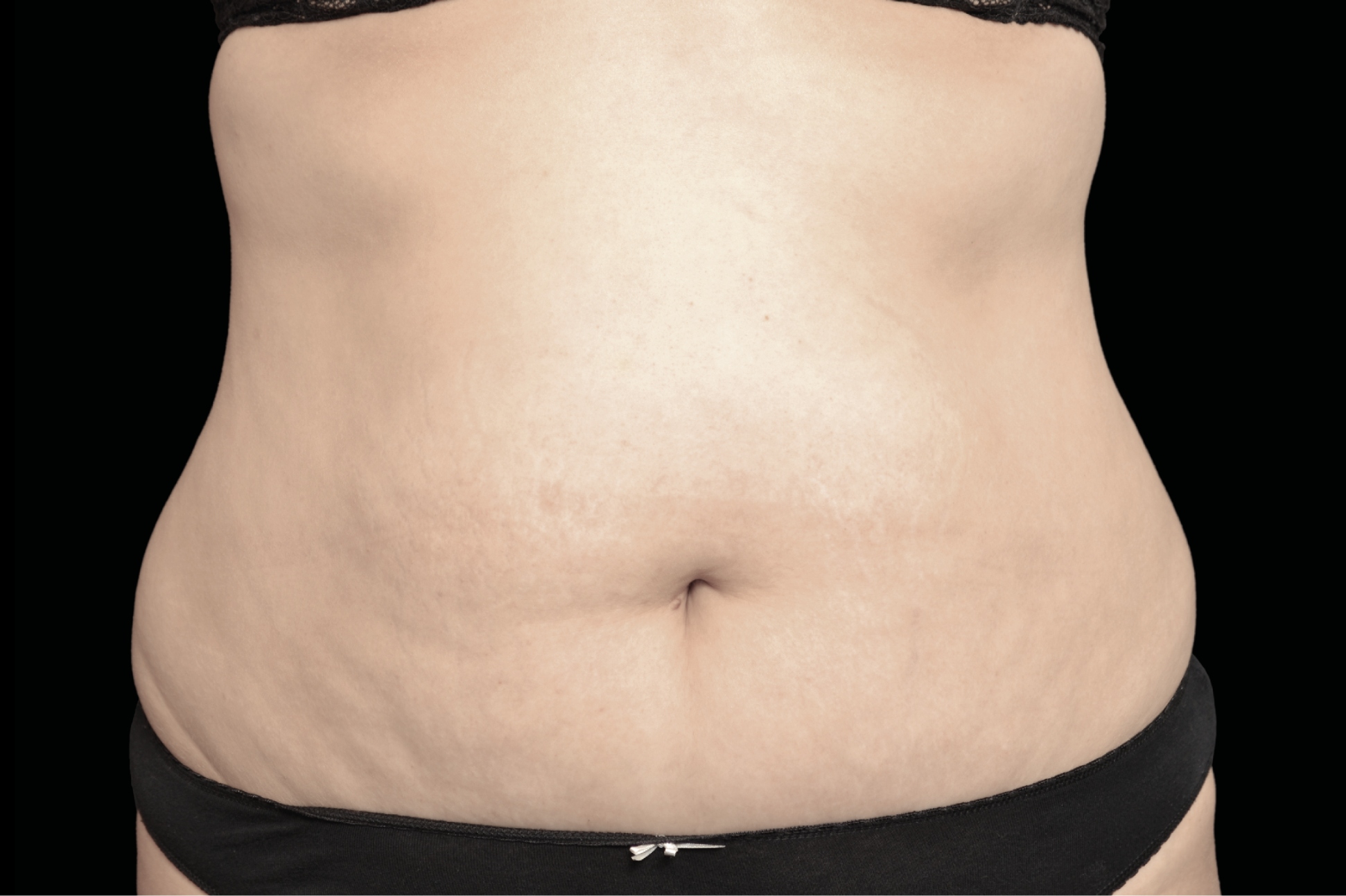 BTL Exilis Ultra Before & After Gallery - Patient 234247 - Image 2