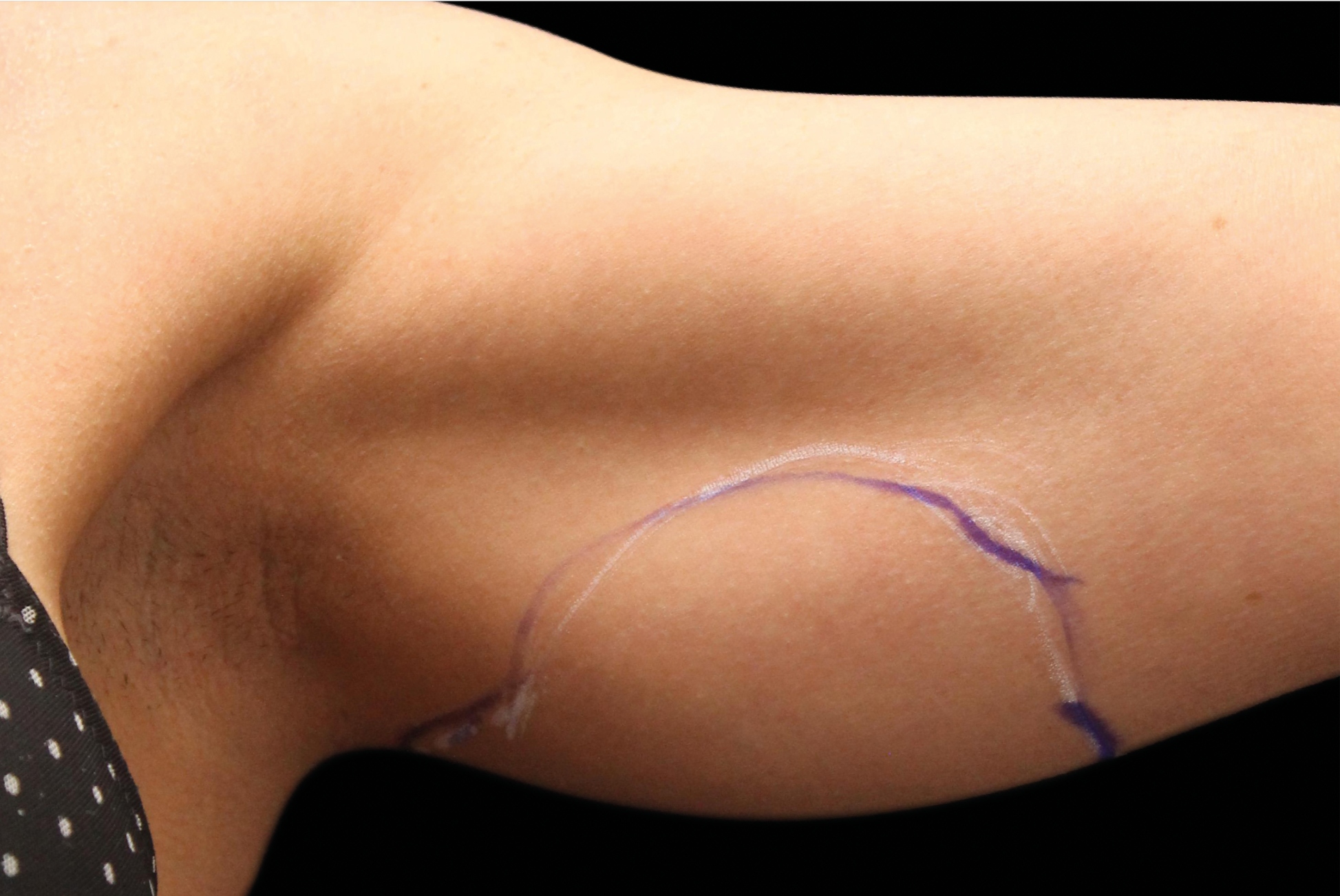 BTL Exilis Ultra Before & After Gallery - Patient 416836 - Image 1