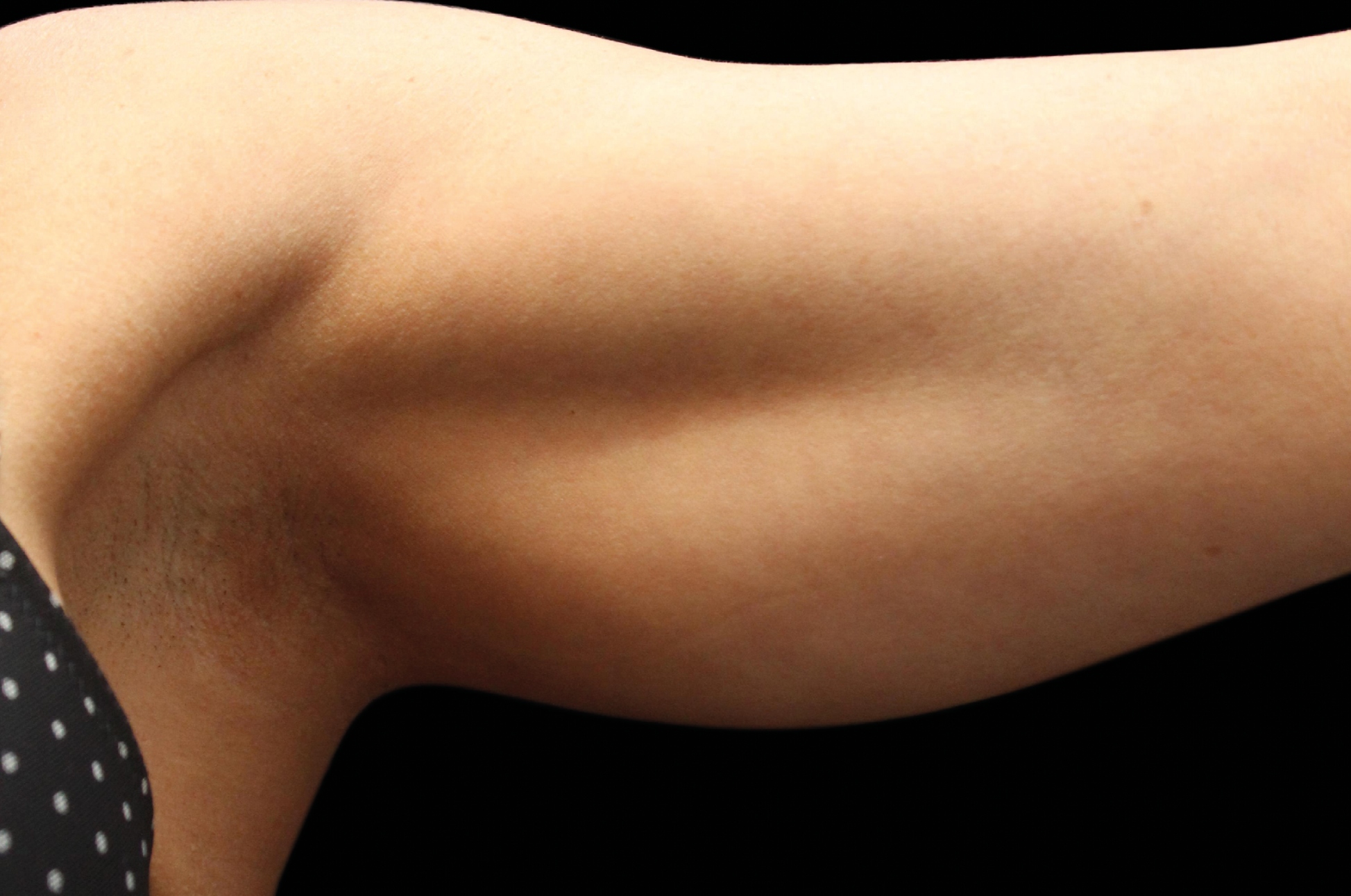 BTL Exilis Ultra Before & After Gallery - Patient 416836 - Image 2