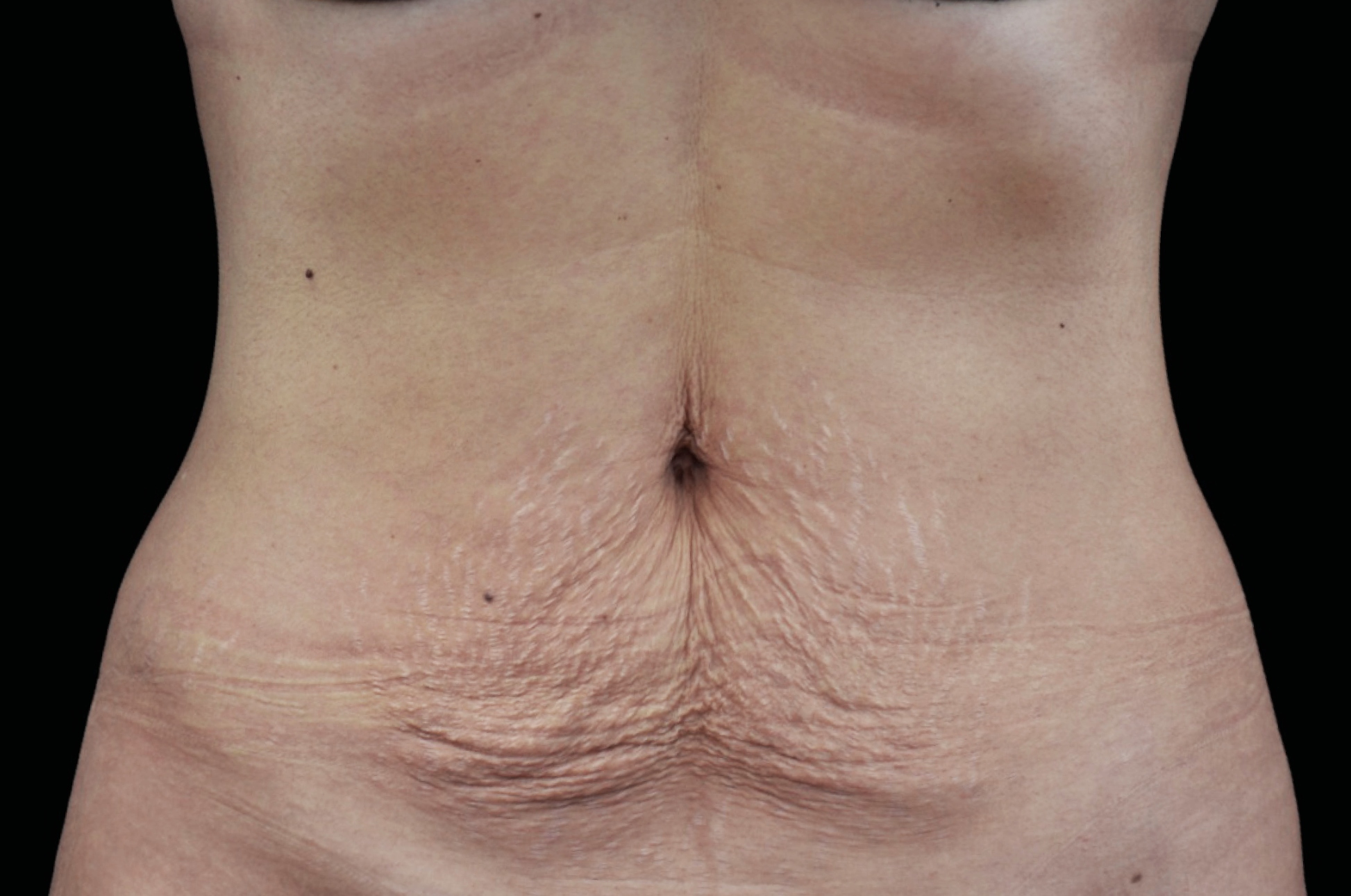 Emtone Before & After Gallery - Patient 233892 - Image 1