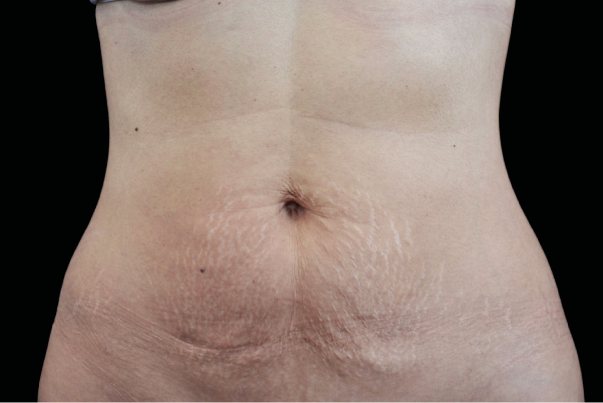 Emtone Before & After Gallery - Patient 233892 - Image 2