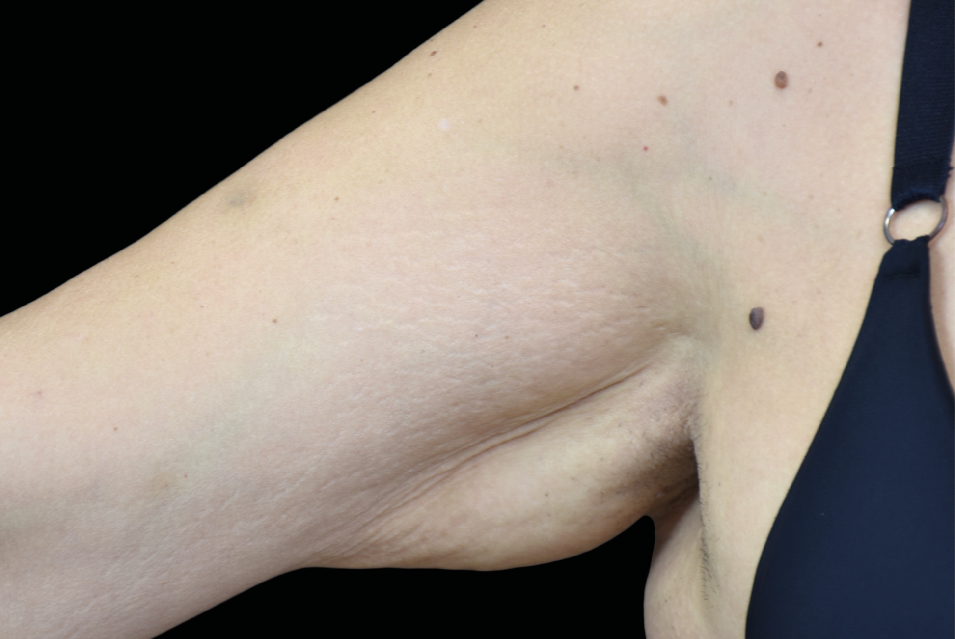 Emtone Before & After Gallery - Patient 106717 - Image 1